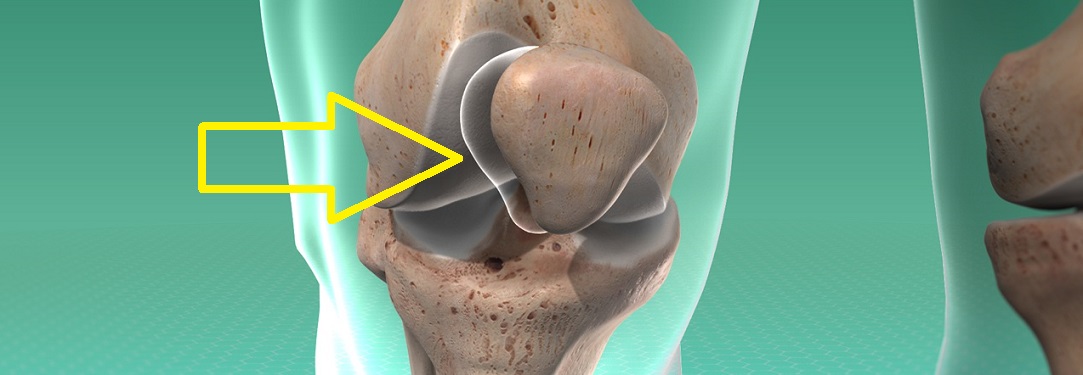 patellar_track_disorder_arr1280